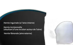 Adapte Hernie Inguinale -gauche-